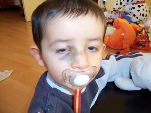 Tymeo Est Tombe Sur Le Nez Photos News Apres Visite Orl Bebe Grandit Forum Grossesse Amp Bebe Doctissimo