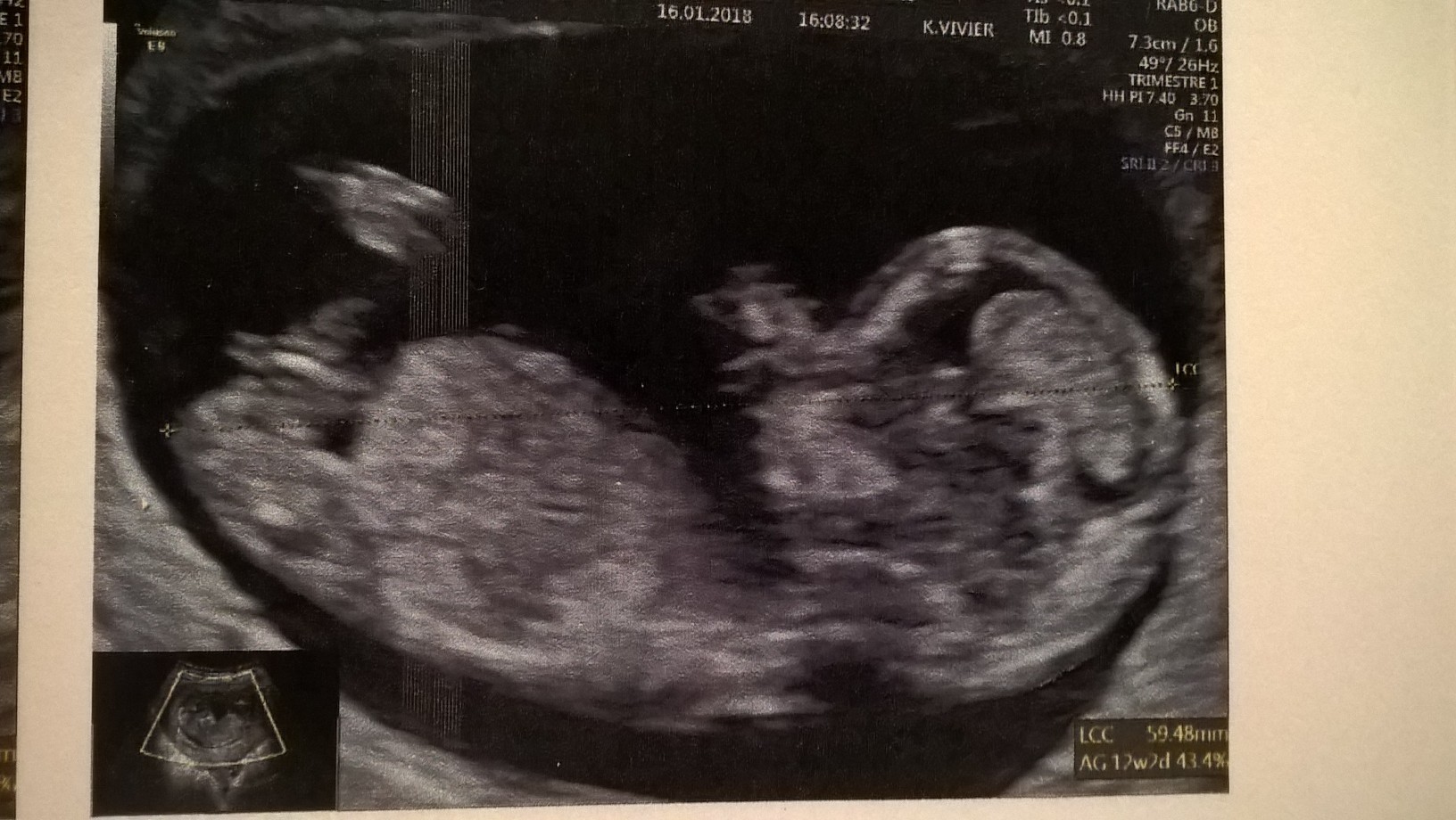 Sexe 12sa 2 Echographie Connaitre Le Sexe De Votre Bebe Forum Grossesse Amp Bebe Doctissimo