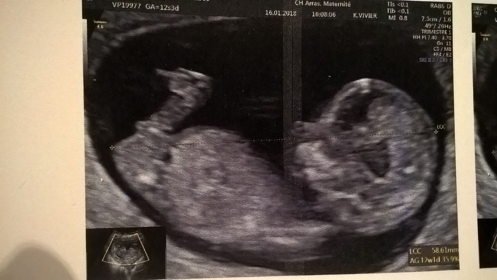 Sexe 12sa 2 Echographie Connaitre Le Sexe De Votre Bebe Forum Grossesse Amp Bebe Doctissimo