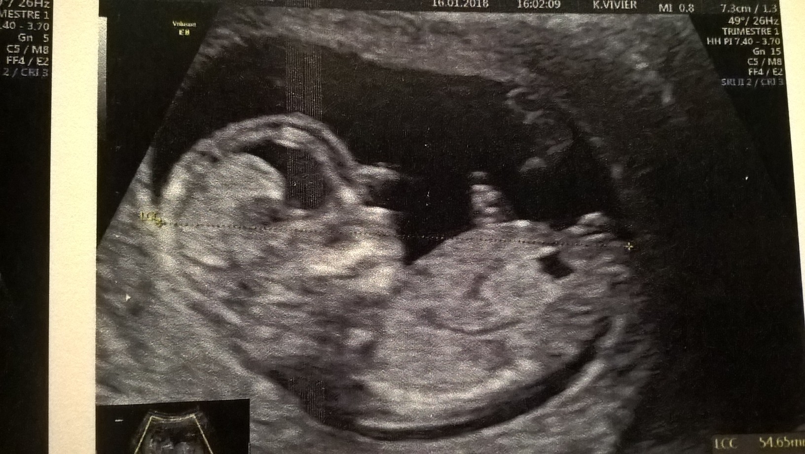 Sexe 12sa 2 Echographie Connaitre Le Sexe De Votre Bebe Forum Grossesse Amp Bebe Doctissimo