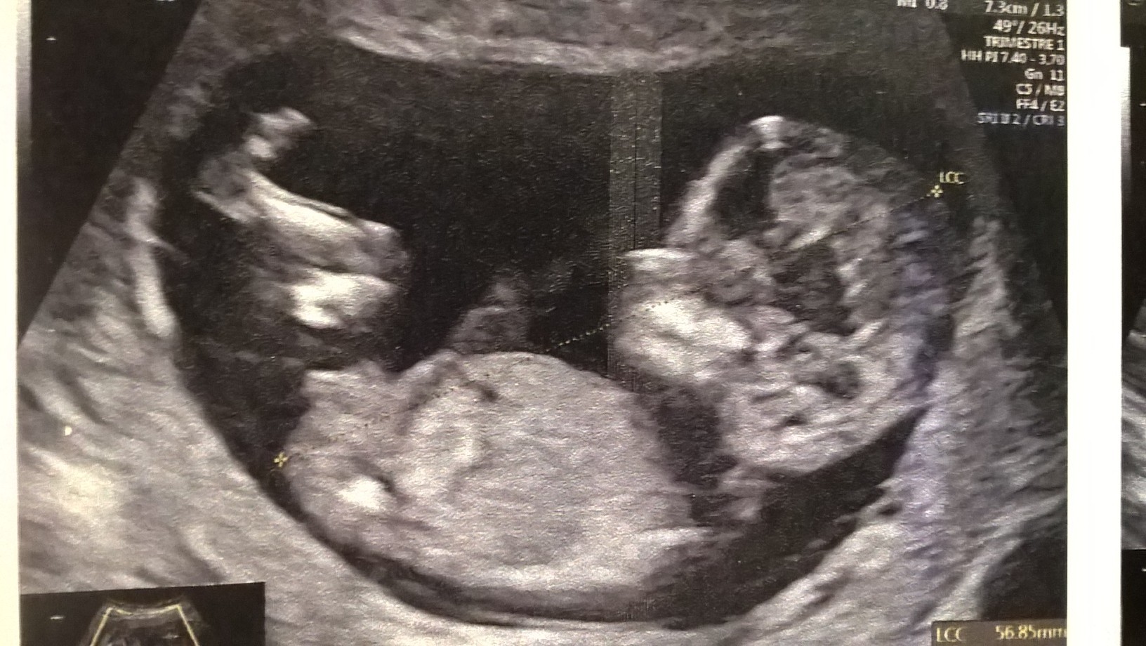 Sexe 12sa 2 Echographie Connaitre Le Sexe De Votre Bebe Forum Grossesse Amp Bebe Doctissimo