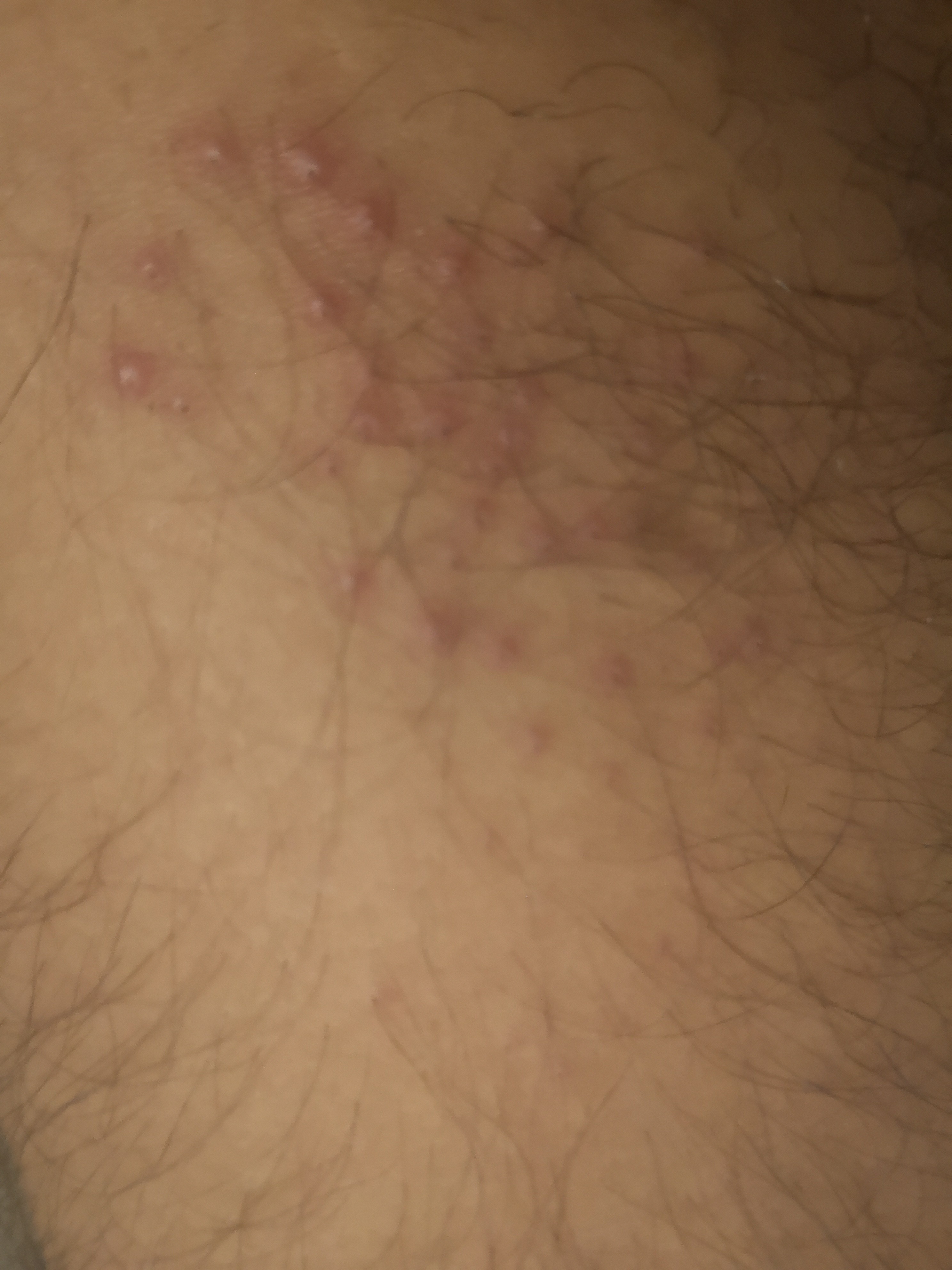 bouton après rasage pubien