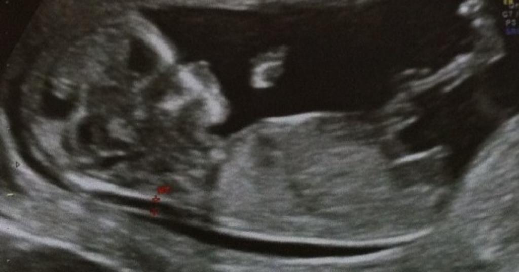 Echo Des 12 Semaines Fille Puis Garcon Et Vous Qu En Pensez Vous Echographie Connaitre Le Sexe De Votre Bebe Forum Grossesse Amp Bebe Doctissimo Echo Des 12 Semaines Fille Puis Garcon Et Vous Qu En Pensez Vous Echographie Connaitre Le Sexe De Votre Bebe Forum Grossesse Amp Bebe Doctissimo