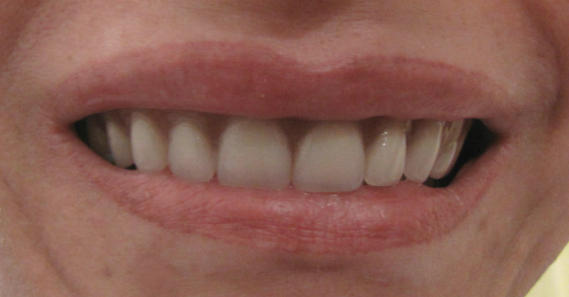 Dentier Bas Ne Tient Pas - Couronnes Sur Les Dents Restantes Du Bas Et Prothèses Dentaire Partielle Amovible Pour Les Dents Manquantes Du Bas.