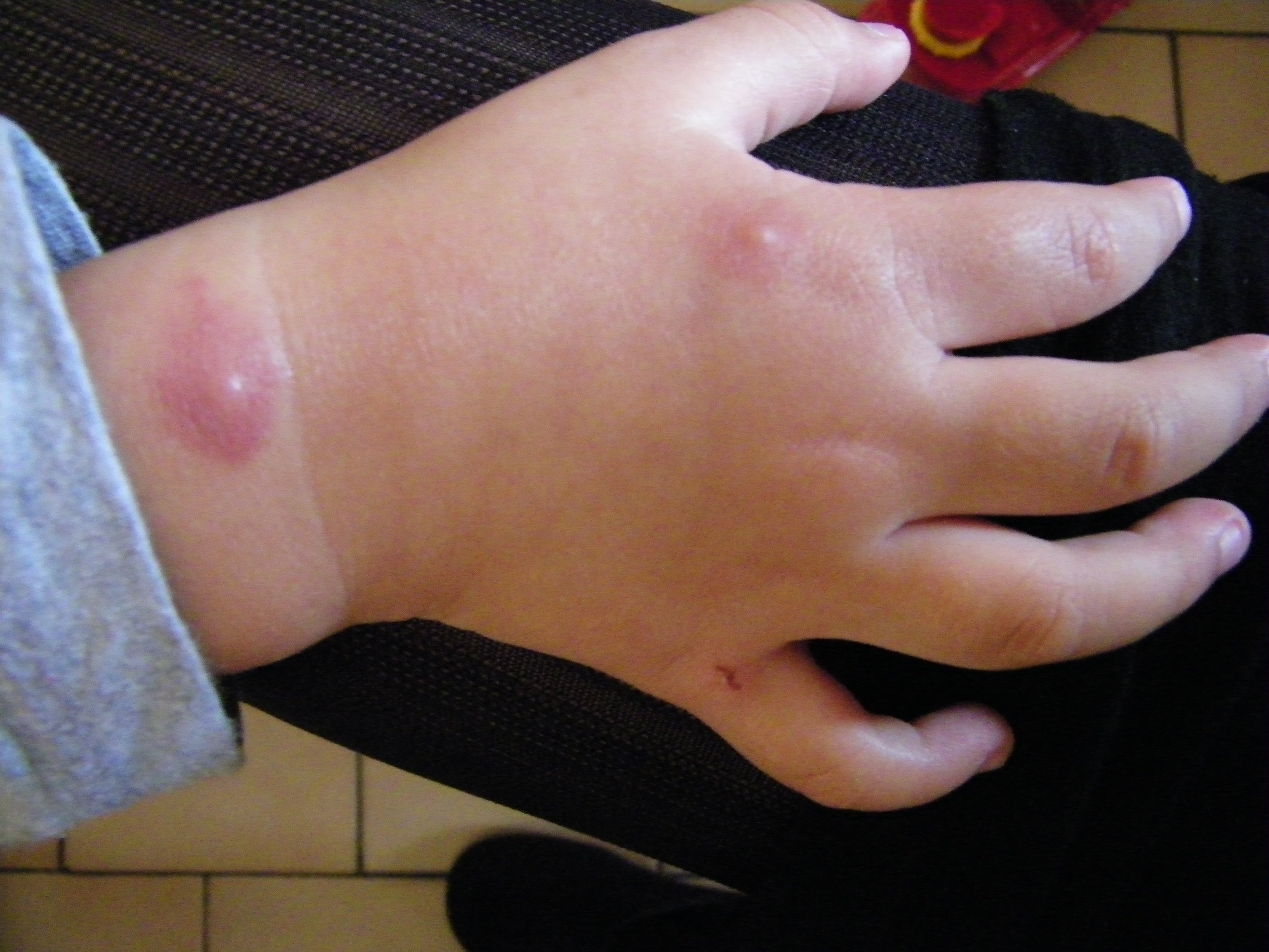Allergie Aux Piqures D Insectes Bebe Grandit Forum Grossesse Amp Bebe Doctissimo Allergie Aux Piqures D Insectes Bebe Grandit Forum Grossesse Amp Bebe Doctissimo