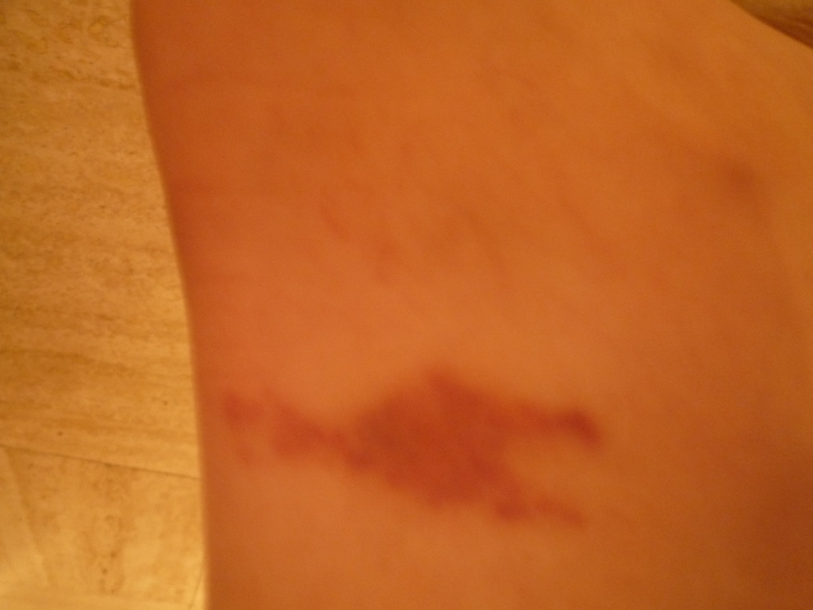 Tache Forme Bizarre Sur Le Pied Forum Libre Sante Forum Sante Doctissimo