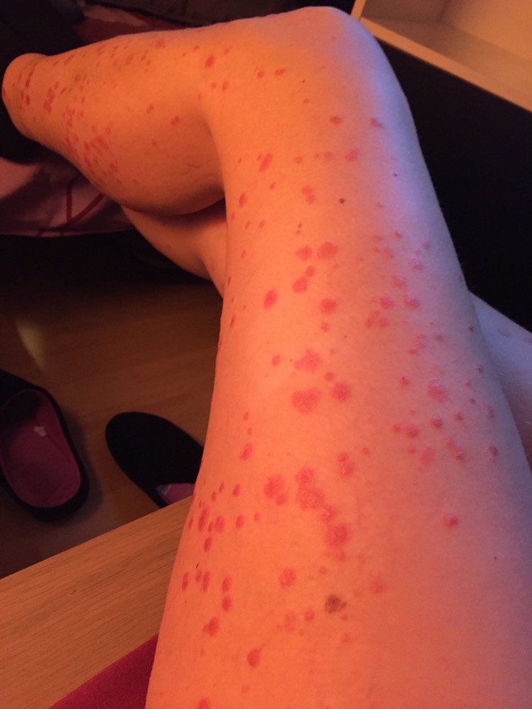 Psoriasis en goutte Psoriasis en goutte