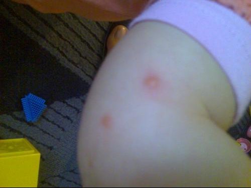 Bouton Bizard Sur Mon Bebe Sante De L Enfant Forum Sante Doctissimo Bouton Bizard Sur Mon Bebe Sante De L Enfant Forum Sante Doctissimo