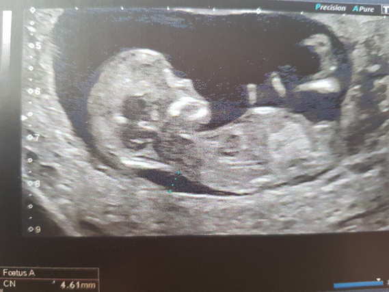 Clarte Nucale A 4 6mm Et Cariotype Normal Clarte Nucale A 4 6mm Et Cariotype Normal