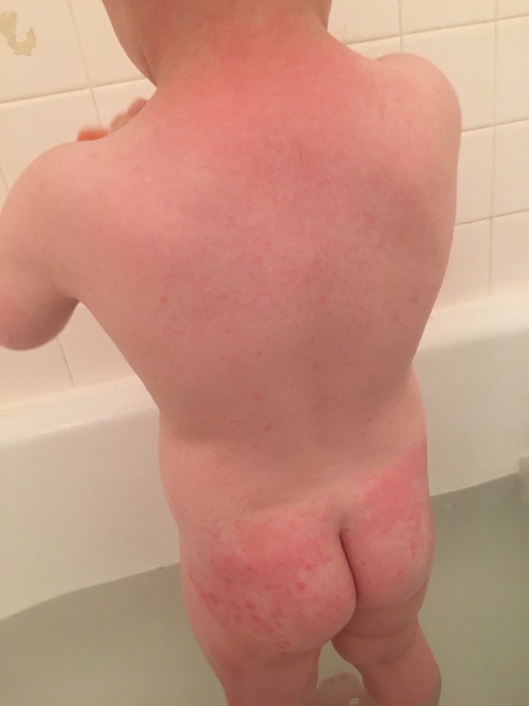 Boutons Partout Sur Le Corps Enfant 2 Ans Et Demi Sante De L Enfant Forum Sante Doctissimo