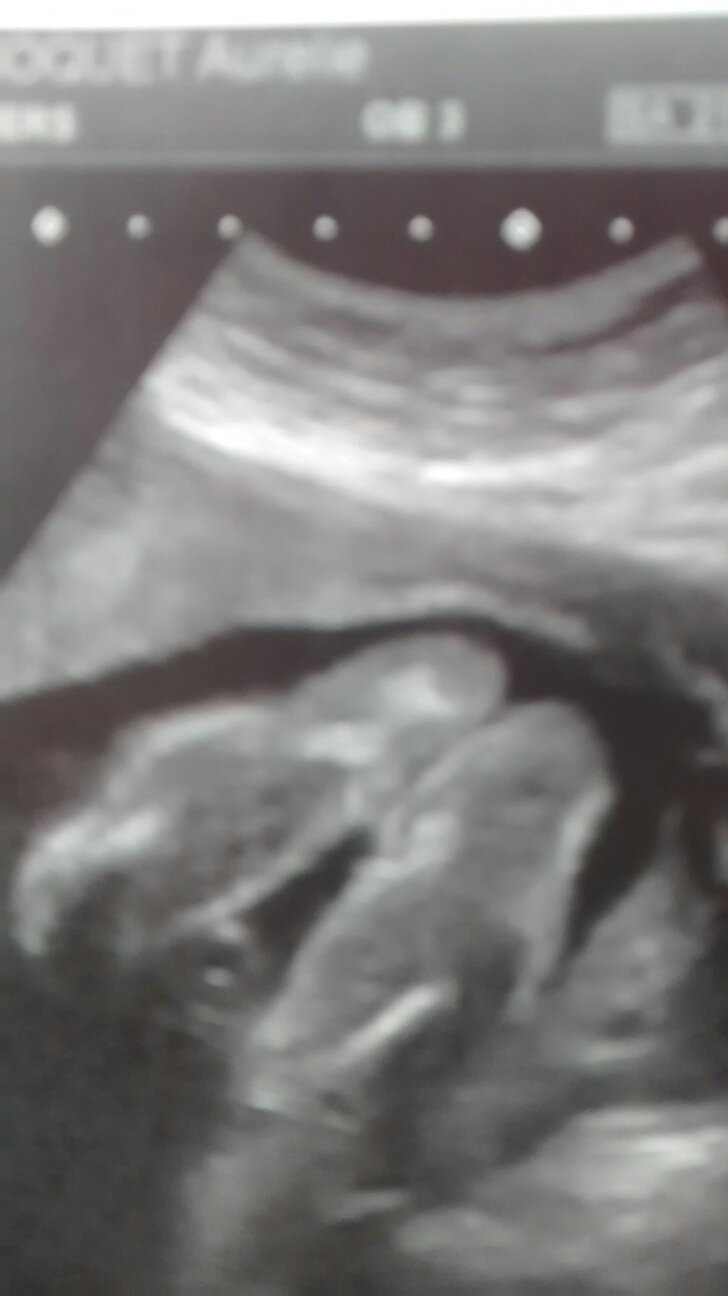 Bebe 21 Sa Echographie Connaitre Le Sexe De Votre Bebe Forum Grossesse Amp Bebe Doctissimo Bebe 21 Sa Echographie Connaitre Le Sexe De Votre Bebe Forum Grossesse Amp Bebe Doctissimo