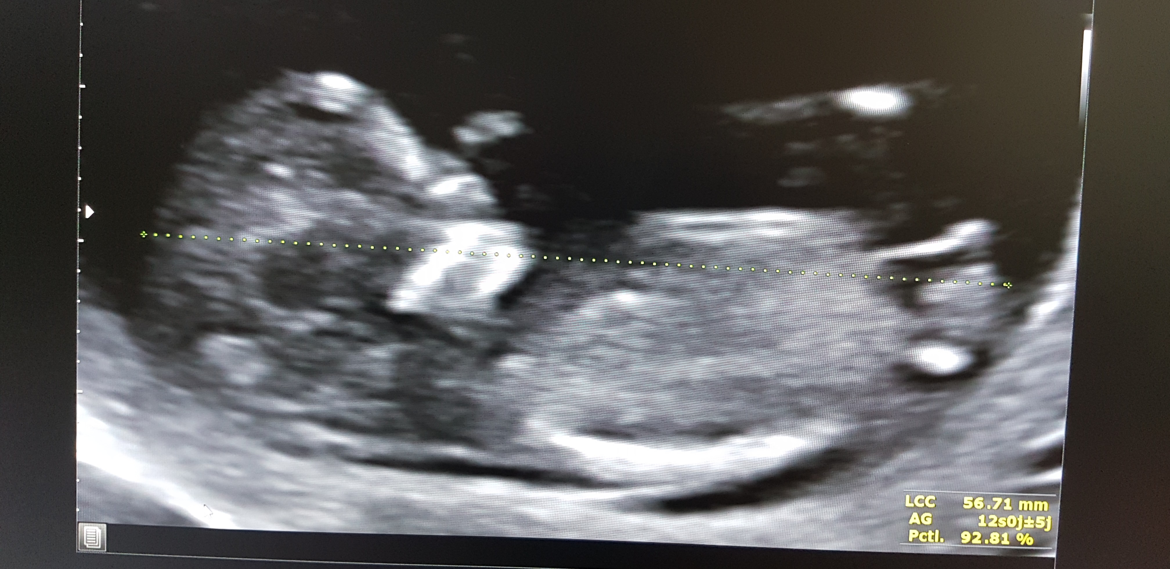 Est Ce Que L On Voit Le Tubercule Genital Echographie Connaitre Le Sexe De Votre Bebe Forum Grossesse Amp Bebe Doctissimo Est Ce Que L On Voit Le Tubercule Genital Echographie Connaitre Le Sexe De Votre Bebe Forum Grossesse Amp Bebe Doctissimo