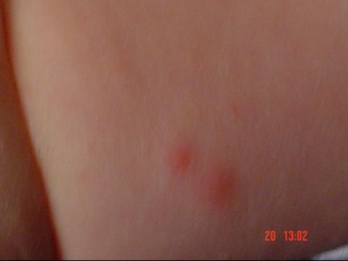 Pensez Vous Que Ce Soit La Varicelle Bebe Grandit Forum Grossesse Amp Bebe Doctissimo Pensez Vous Que Ce Soit La Varicelle Bebe Grandit Forum Grossesse Amp Bebe Doctissimo