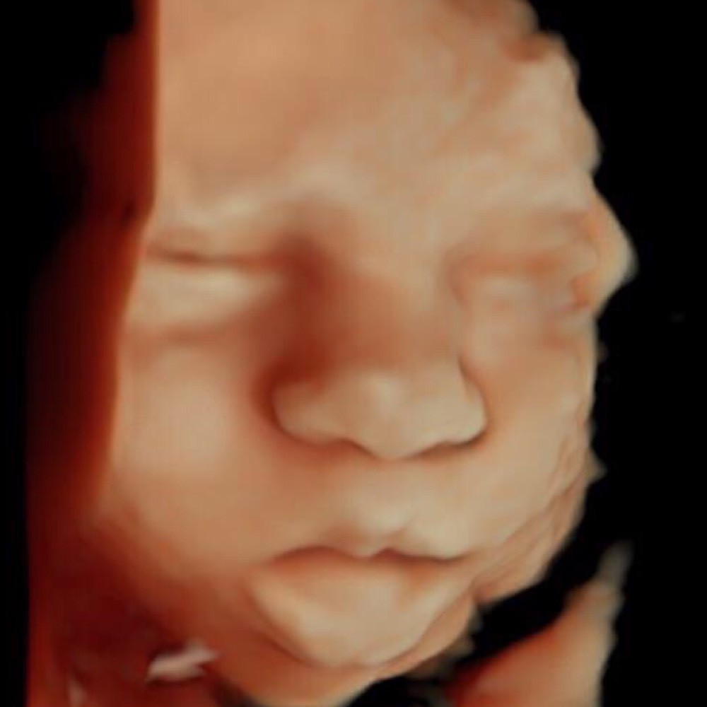 Echographie 3d Grossesse Forum Grossesse Amp Bebe Doctissimo Echographie 3d Grossesse Forum Grossesse Amp Bebe Doctissimo