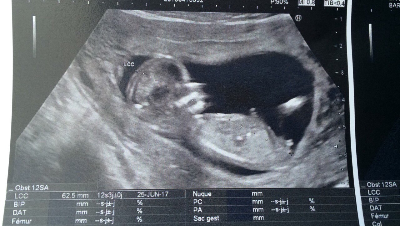 Avis Sexe Echo 12sa 3 Echographie Connaitre Le Sexe De Votre Bebe Forum Grossesse Amp Bebe Doctissimo