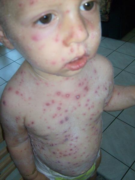 Hs Varicelle Allaitement Forum Grossesse Amp Bebe Doctissimo Hs Varicelle Allaitement Forum Grossesse Amp Bebe Doctissimo