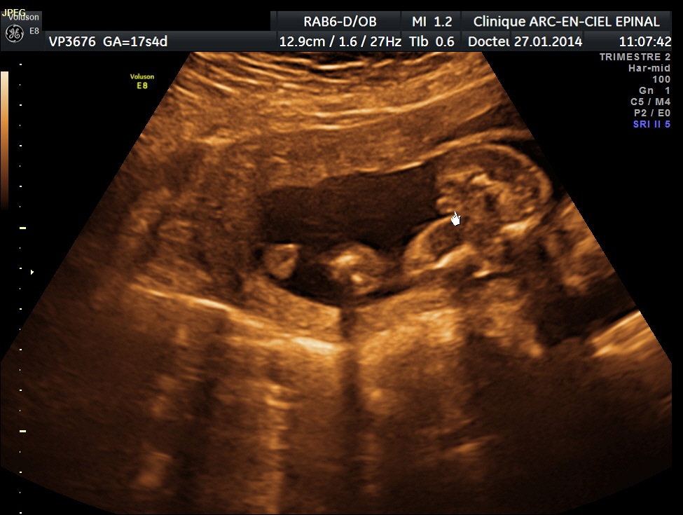 17sa 4 Vue Des Fesses Presque Du Dos Echographie Connaitre Le Sexe De Votre Bebe Forum Grossesse Amp Bebe Doctissimo