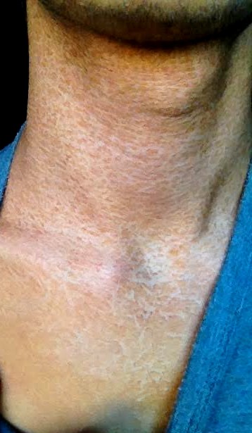 Mon Autobronzant A Tourne Au Drame Preuve En Image Bronzage Soleil Et Uv Forum Beaute Doctissimo Mon Autobronzant A Tourne Au Drame Preuve En Image Bronzage Soleil Et Uv Forum Beaute Doctissimo