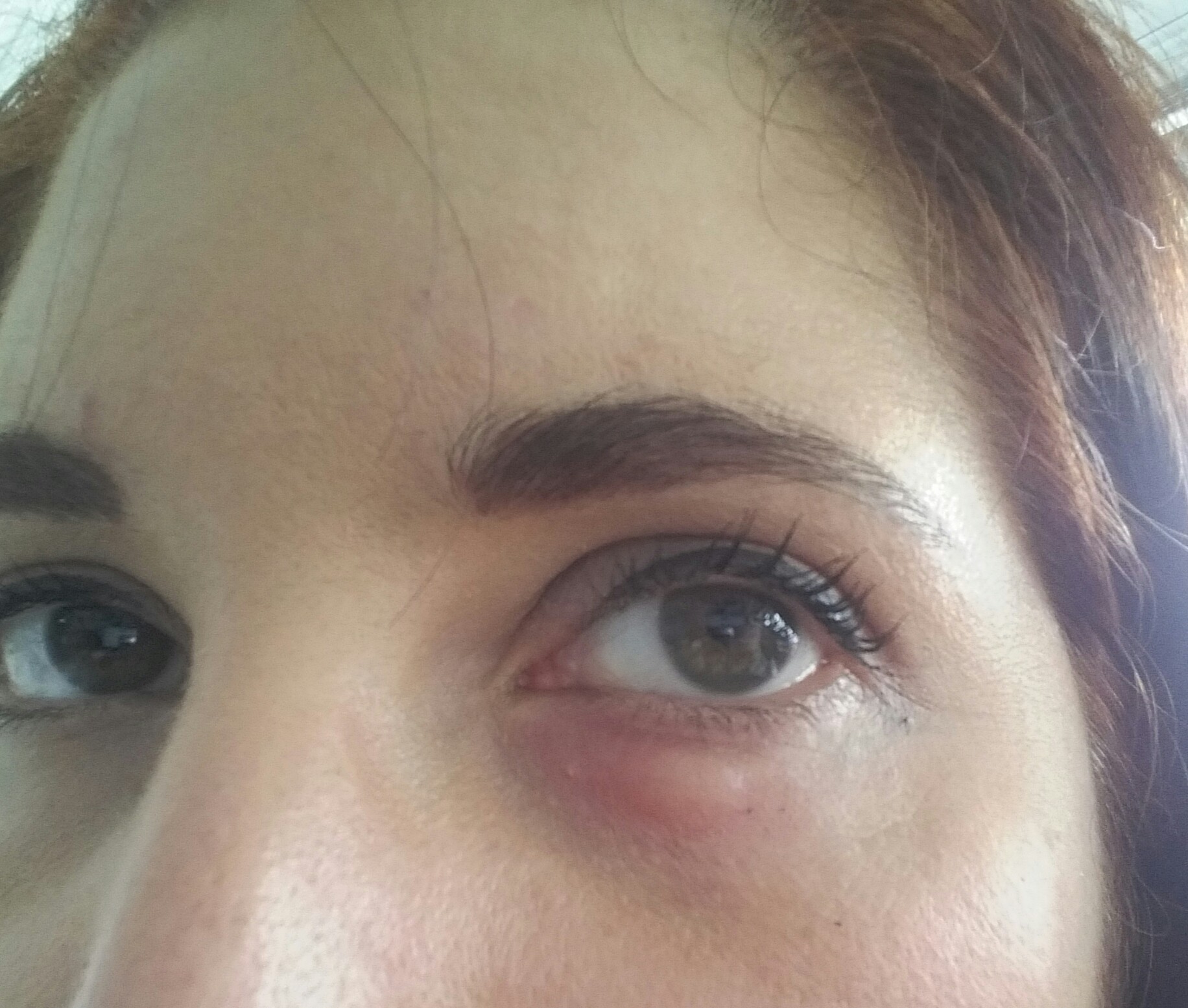 Oedeme Sous L Oeil Allergies Et Eczema Forum Sante Doctissimo Oedeme Sous L Oeil Allergies Et Eczema Forum Sante Doctissimo