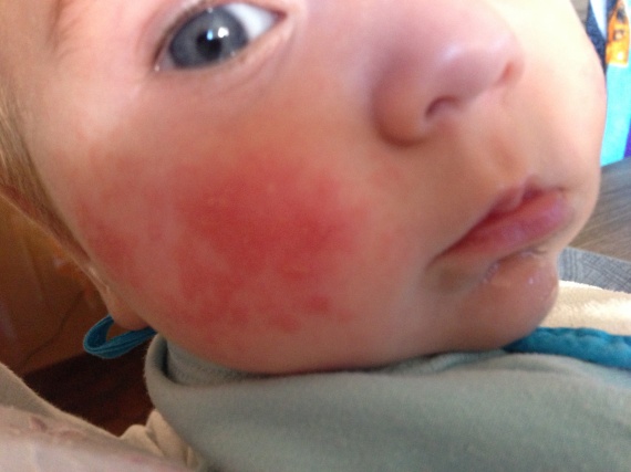 Petites Plaques Rouges Due Allaitement Petites Plaques Rouges Due Allaitement