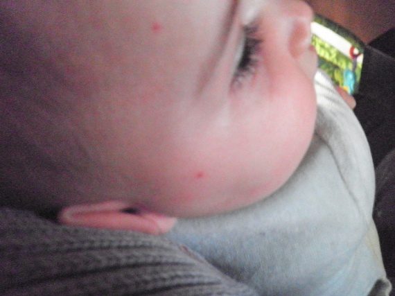 Petits Boutons Rouges Sr Le Visage Petits Boutons Rouges Sr Le Visage