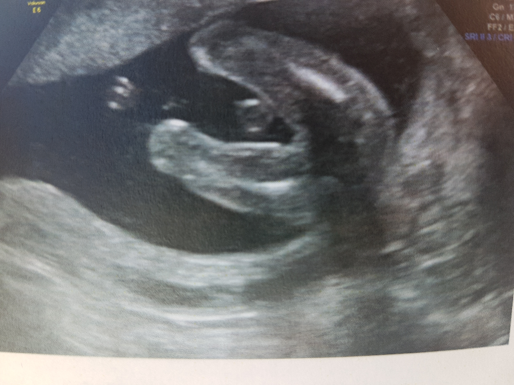 Echo 18sa 5 Echographie Connaitre Le Sexe De Votre Bebe Forum Grossesse Amp Bebe Doctissimo