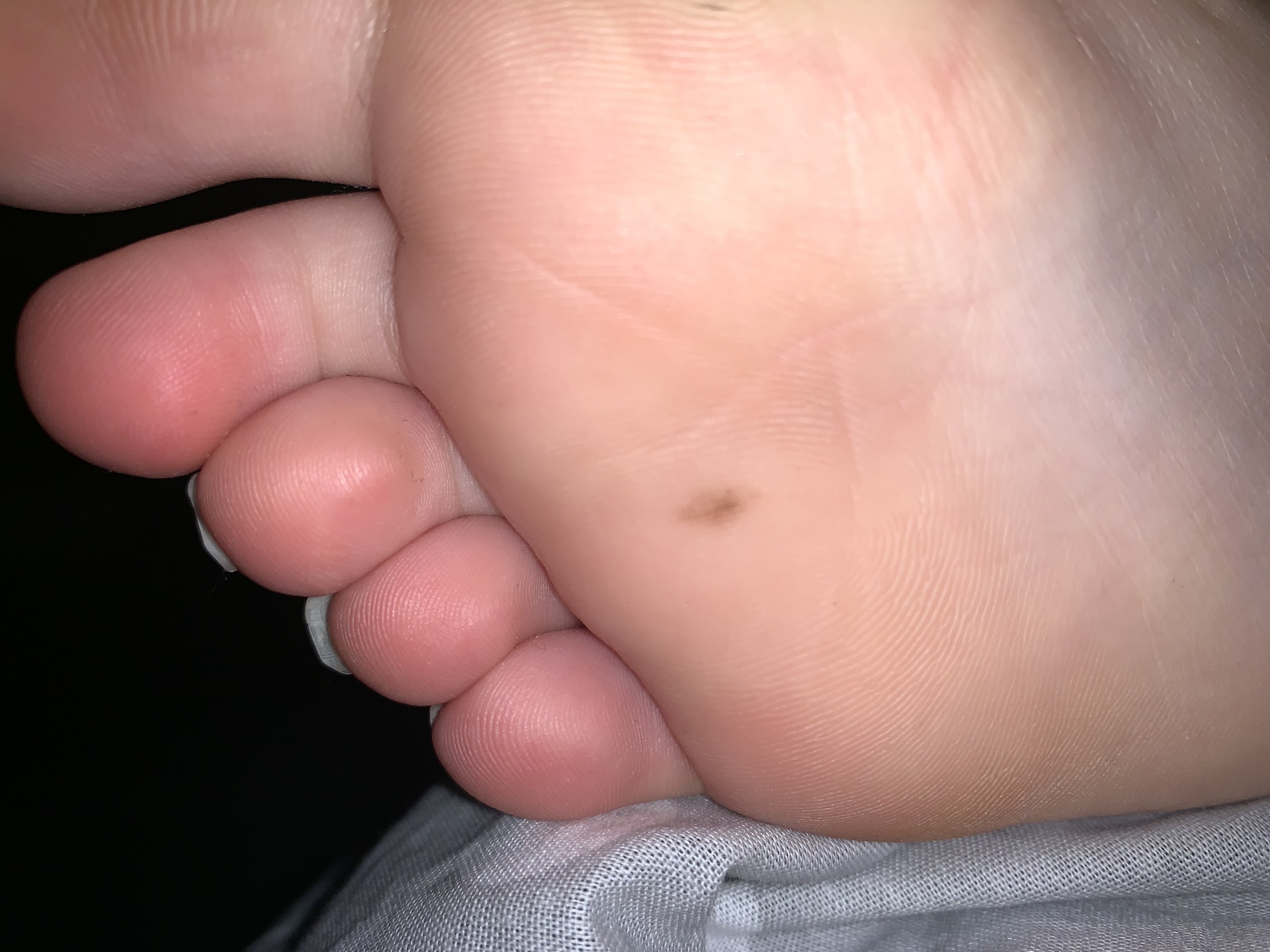 Tache Brune Sous Le Pied Cancer S Forum Sante Doctissimo Tache Brune Sous Le Pied Cancer S Forum Sante Doctissimo