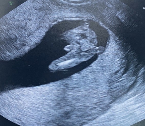 Echo Fille Ou Garcon Echo Fille Ou Garcon