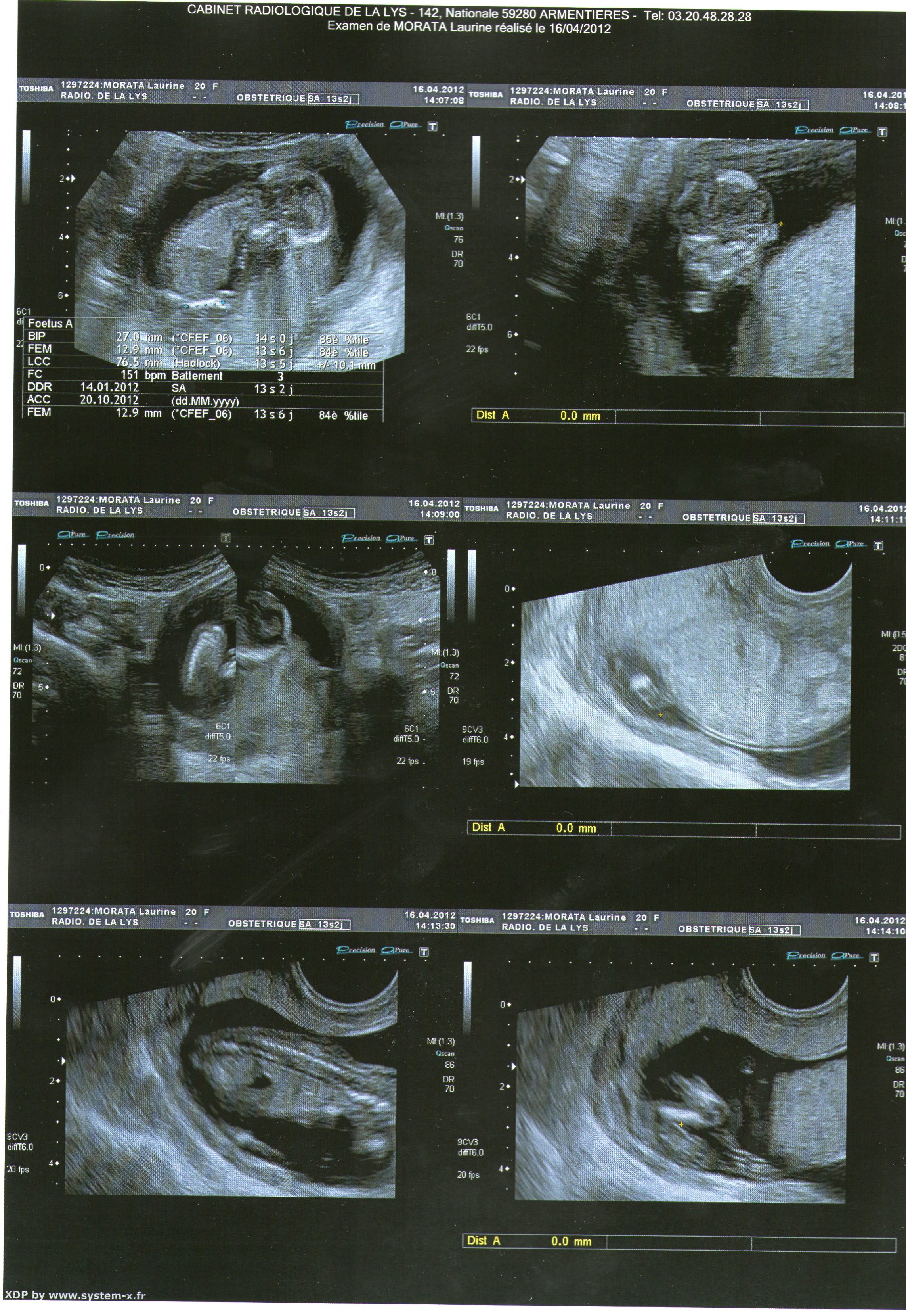 Echo D Une Amie Pour Savoir Le Sexe Echographie Connaitre Le Sexe De Votre Bebe Forum Grossesse Amp Bebe Doctissimo