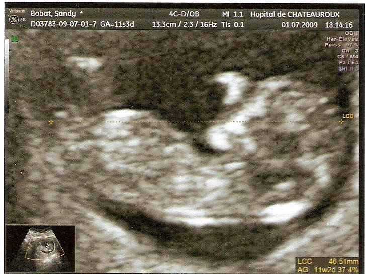 Eco Des 12 Sa Voyez Vous Un Gars Ou Une Fille Echographie Connaitre Le Sexe De Votre Bebe Forum Grossesse Amp Bebe Doctissimo