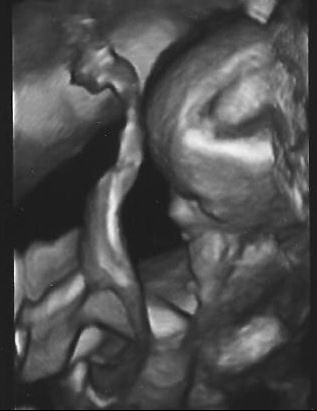 Clarte Nucale Besoin De Votre Avis Echographie Connaitre Le Sexe De Votre Bebe Forum Grossesse Amp Bebe Doctissimo Clarte Nucale Besoin De Votre Avis Echographie Connaitre Le Sexe De Votre Bebe Forum Grossesse Amp Bebe Doctissimo