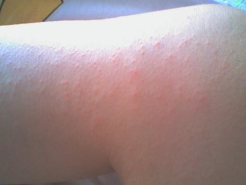 Petits Boutons Sur Jambes Petits Boutons Sur Jambes