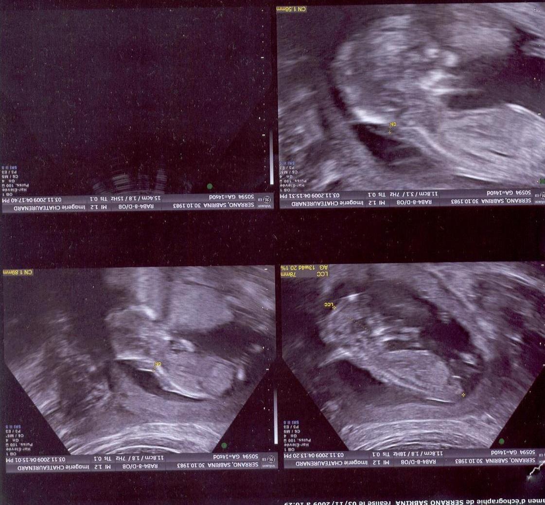 Quelqun Pour Avis Sexe Bebe Echographie Connaitre Le Sexe De Votre Bebe Forum Grossesse Amp Bebe Doctissimo Quelqun Pour Avis Sexe Bebe Echographie Connaitre Le Sexe De Votre Bebe Forum Grossesse Amp Bebe Doctissimo