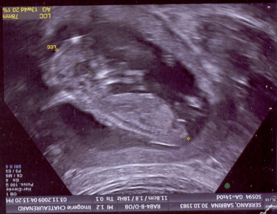 Quelqun Pour Avis Sexe Bebe Echographie Connaitre Le Sexe De Votre Bebe Forum Grossesse Amp Bebe Doctissimo Quelqun Pour Avis Sexe Bebe Echographie Connaitre Le Sexe De Votre Bebe Forum Grossesse Amp Bebe Doctissimo