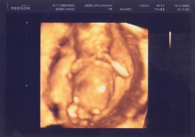 Verdict A 14sa Echo 3d Echographie Connaitre Le Sexe De Votre Bebe Forum Grossesse Amp Bebe Doctissimo Verdict A 14sa Echo 3d Echographie Connaitre Le Sexe De Votre Bebe Forum Grossesse Amp Bebe Doctissimo