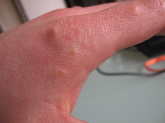 bouton situé principalement sur les mains. - Allergies et eczéma ...