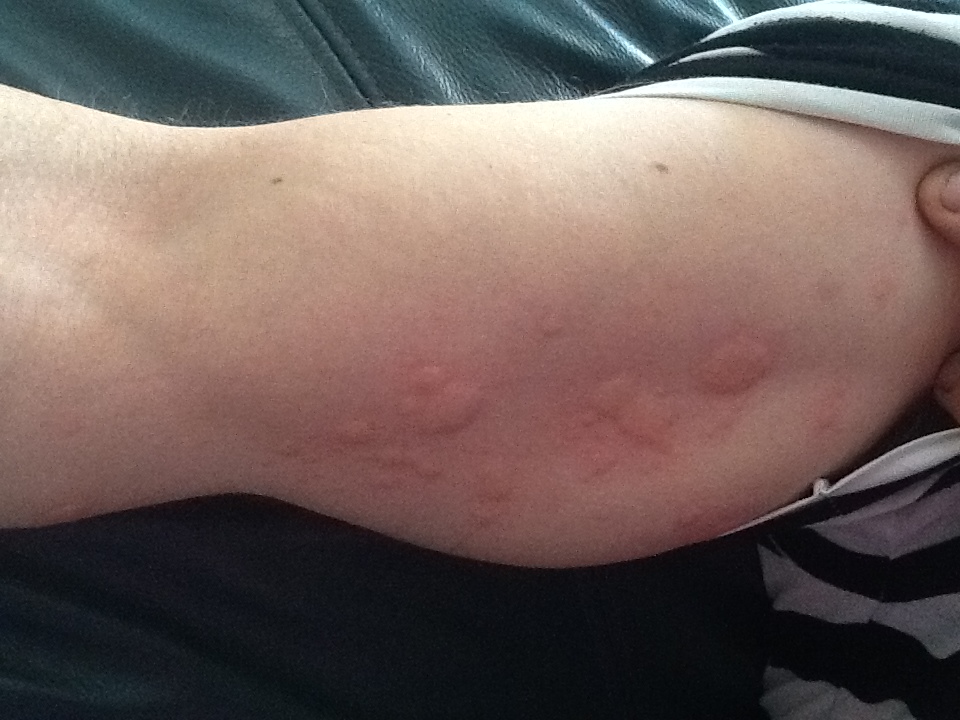 Bouton Comme Piqure De Moustique Allergies Et Eczema Forum Sante Doctissimo Bouton Comme Piqure De Moustique Allergies Et Eczema Forum Sante Doctissimo