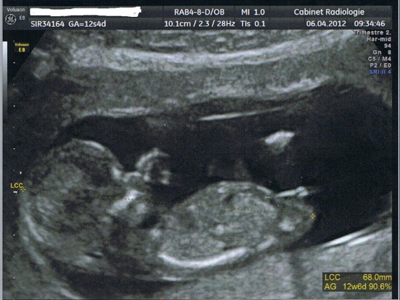 Aux Pros Du Tubercule Svp Bourgeon Bien Visible Aux Pros Du Tubercule Svp Bourgeon Bien Visible