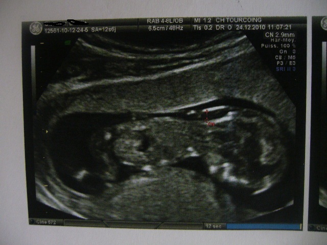 Clarte Nucale 2 9 Mm Tri Test 1 238 Amnio Le 18 Janv Amniocentese Forum Grossesse Amp Bebe Doctissimo Clarte Nucale 2 9 Mm Tri Test 1 238 Amnio Le 18 Janv Amniocentese Forum Grossesse Amp Bebe Doctissimo