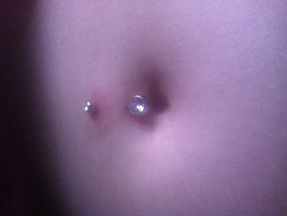 Rejet Infection Nombril Rejet Infection Nombril