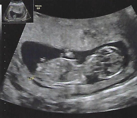 Echographie 13 Sa Une Idee Du Sexe Echographie Connaitre Le Sexe De Votre Bebe Forum Grossesse Amp Bebe Doctissimo