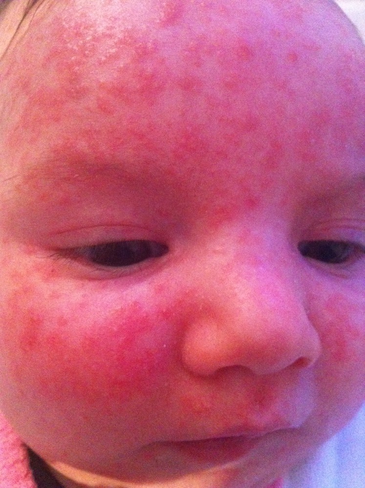 Acne De Bebe Ou Allergie Bebe Grandit Forum Grossesse Amp Bebe Doctissimo Acne De Bebe Ou Allergie Bebe Grandit Forum Grossesse Amp Bebe Doctissimo