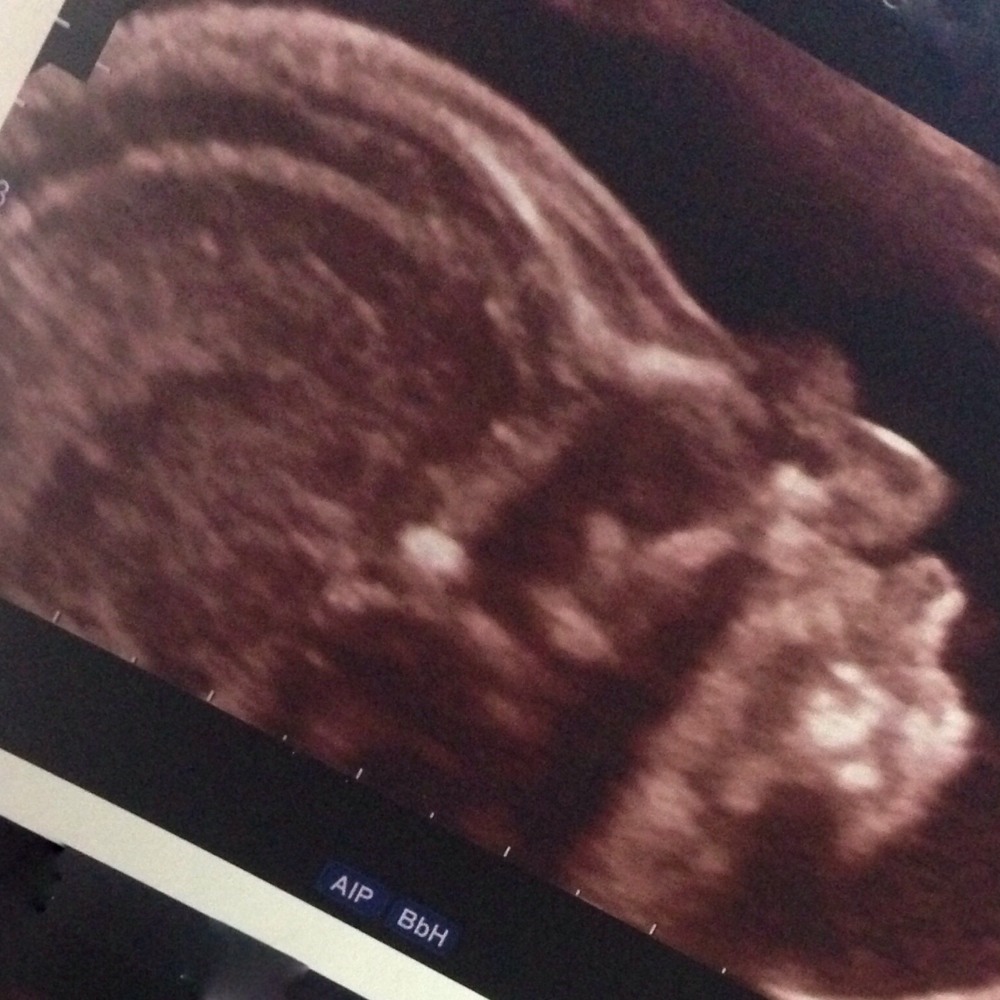 Hygroma Cervical 21sa Amniocentese Forum Grossesse Amp Bebe Doctissimo