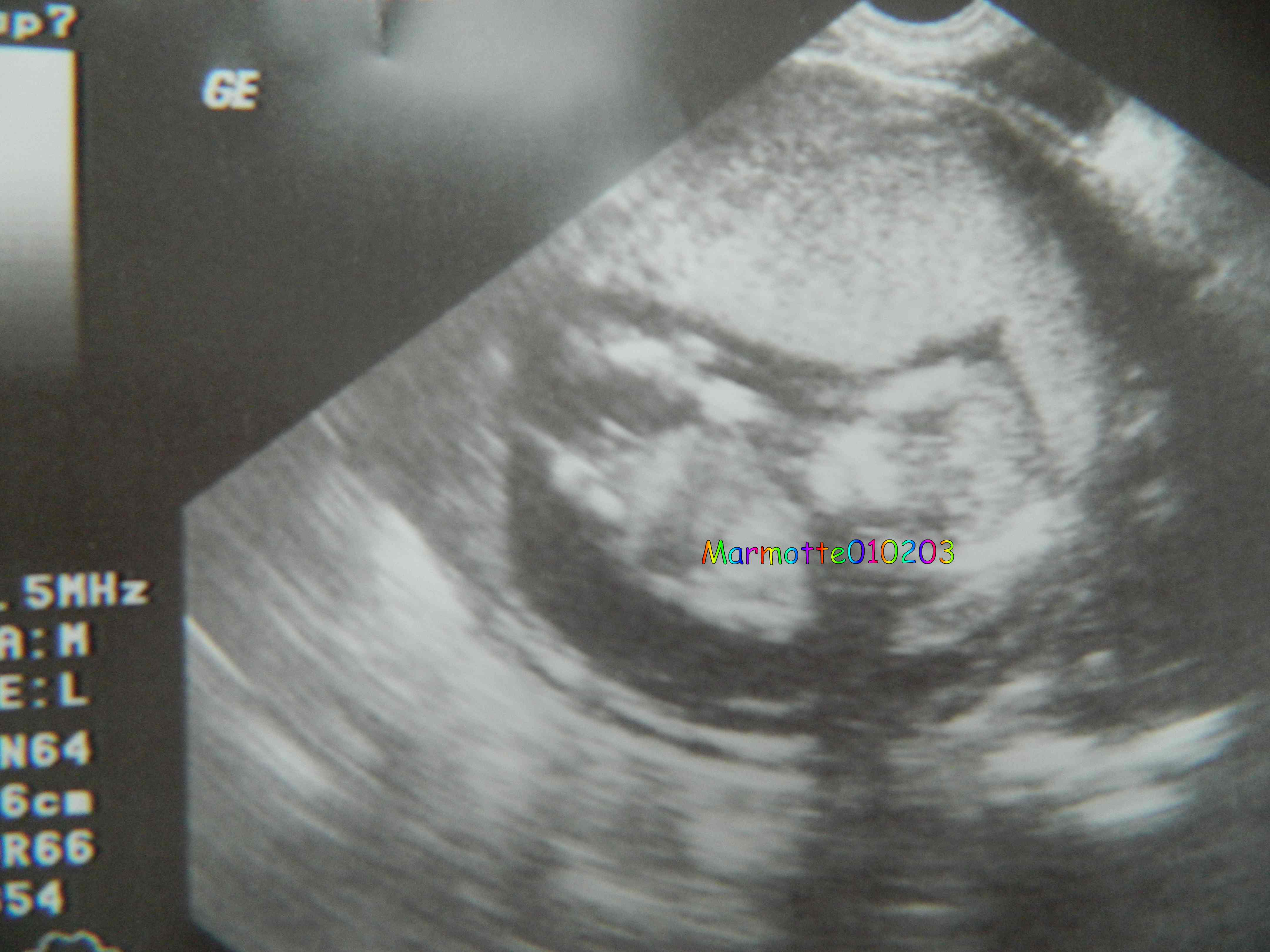 Echo 14 Sa Fille Ou Garcons Echographie Connaitre Le Sexe De Votre Bebe Forum Grossesse Amp Bebe Doctissimo