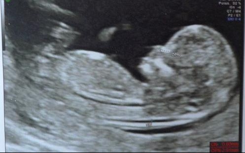Sexe Bebe A 14sg 16sa C Est Une Fille Echographie Connaitre Le Sexe De Votre Bebe Forum Grossesse Amp Bebe Doctissimo Sexe Bebe A 14sg 16sa C Est Une Fille Echographie Connaitre Le Sexe De Votre Bebe Forum Grossesse Amp Bebe Doctissimo