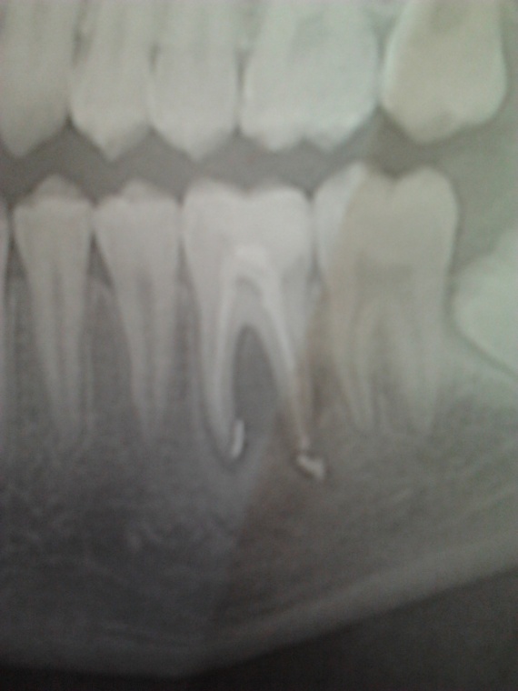 Infection a la racine d