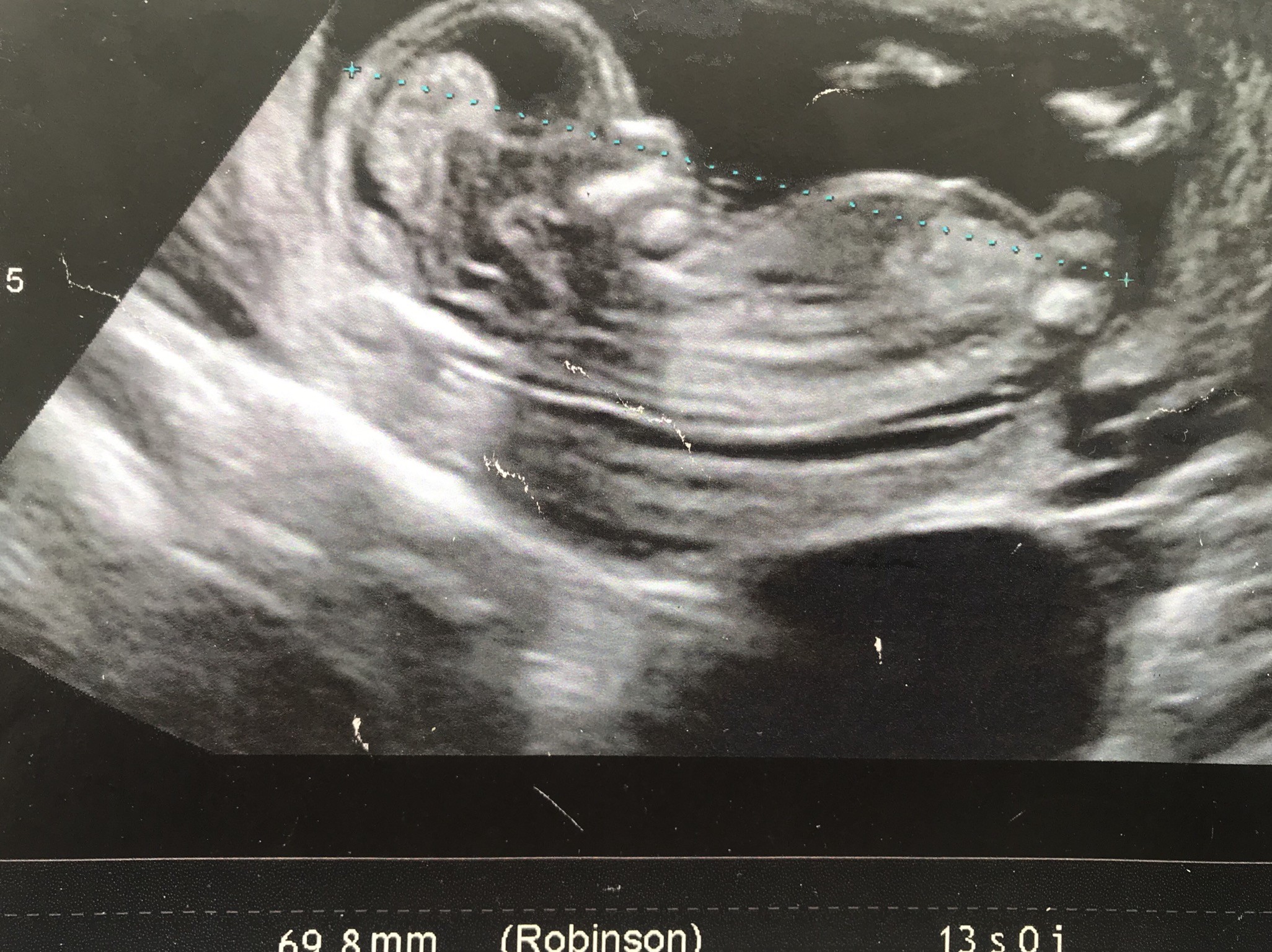 Devinette Tubercule Echographie Connaitre Le Sexe De Votre Bebe Forum Grossesse Amp Bebe Doctissimo Devinette Tubercule Echographie Connaitre Le Sexe De Votre Bebe Forum Grossesse Amp Bebe Doctissimo