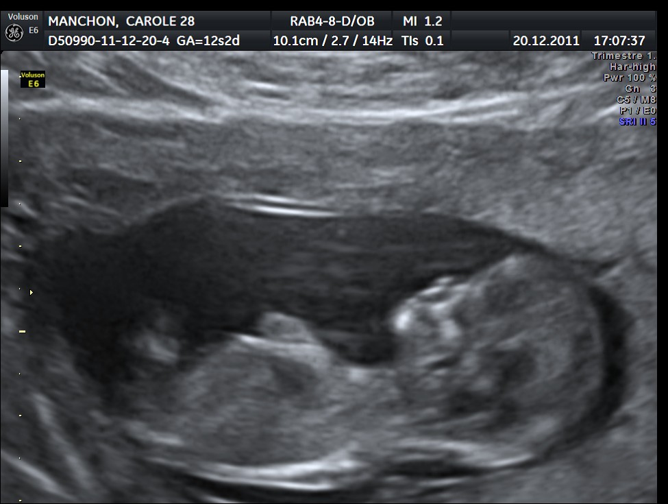 Sexe De Mon Bebe A Diferen Stade Dela Grossesse Si Sa Pe Aide D Fille Echographie Connaitre Le Sexe De Votre Bebe Forum Grossesse Amp Bebe Doctissimo Sexe De Mon Bebe A Diferen Stade Dela Grossesse Si Sa Pe Aide D Fille Echographie Connaitre Le Sexe De Votre Bebe Forum Grossesse Amp Bebe Doctissimo