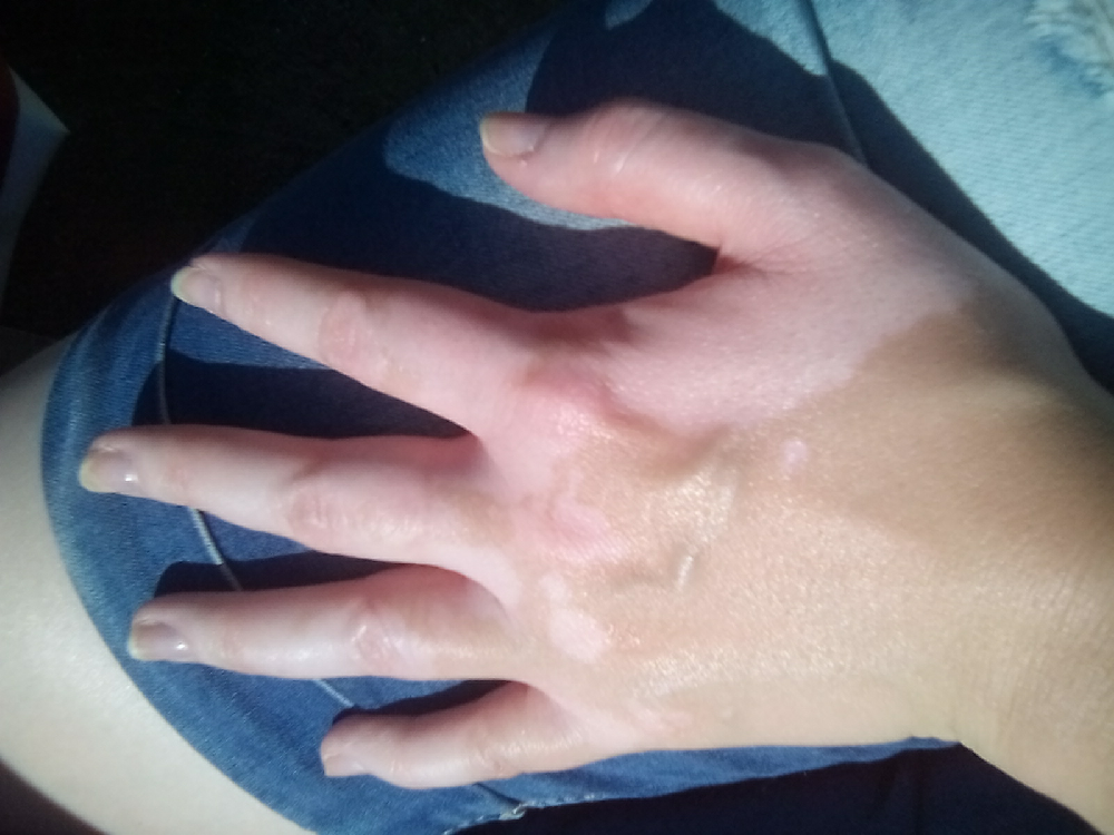 Tache Orange Sur Les Mains Au Réveil