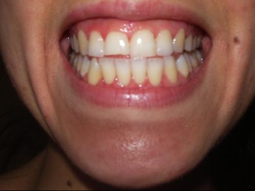 Dent Casseeeee Photos Avant Apres Beaute Des Dents Forum
